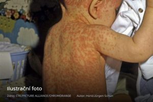 spalničky u dětí, jedna z nejčastějších příčin úmrtí