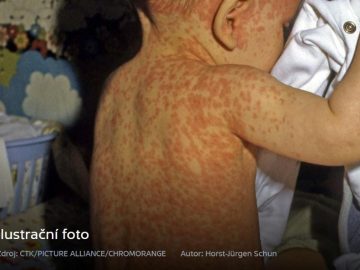 spalničky u dětí, jedna z nejčastějších příčin úmrtí